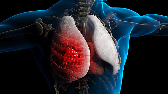 肺病肺癌3D疾病场景背景图片