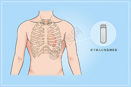皮下植入心电监测设备治疗心脏病医疗插画高清图片