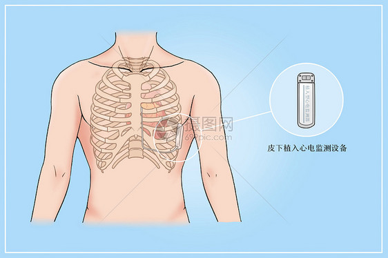 皮下植入心电监测设备治疗心脏病医疗插画图片