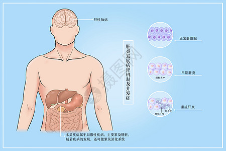 肝炎发展病理机制及并发症医疗插画背景图片