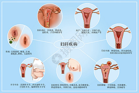 妇科病医疗插画高清图片