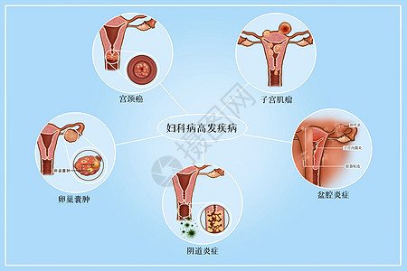 妇科病高发疾病医疗插画高清图片