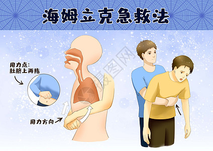 炸食海姆立克急救法插画