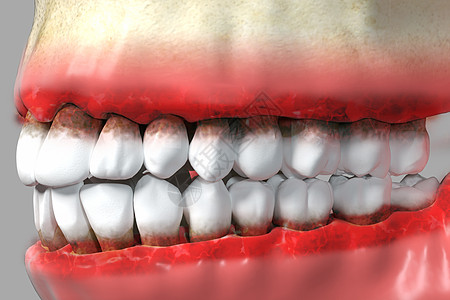三维牙龈炎疾病背景图片