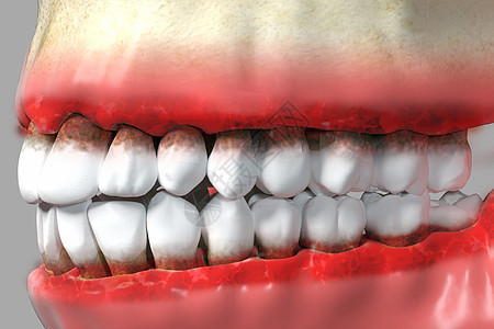 三维牙龈炎疾病背景图片