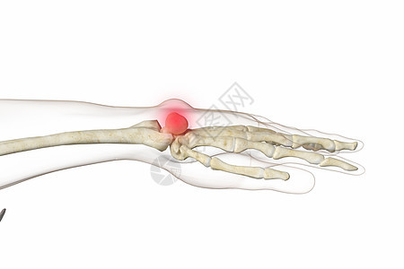 三维腱鞘囊肿场景图片