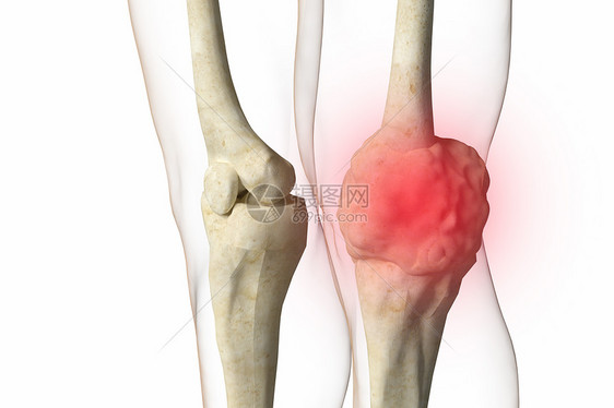 三维骨肉瘤场景图片