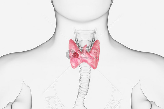 甲状腺结节图片