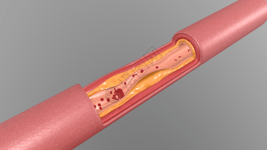 三维血管堵塞场景图片