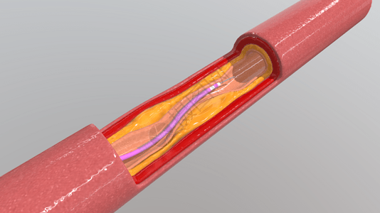 三维血管支架放置过程高清图片
