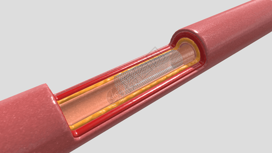 三维血管支架放置完成高清图片