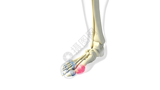大脚趾跖趾关节滑膜图片