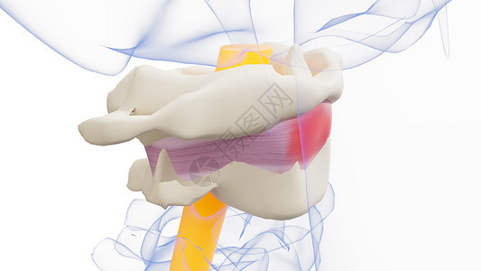 颈椎类风湿性关节炎图片