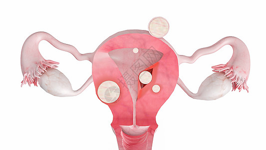 子宫肌瘤血管下子宫瘤右侧高清图片