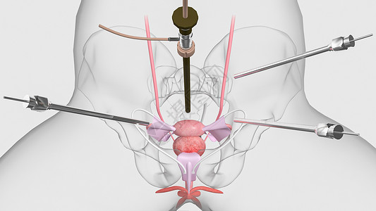 子宫切除手术端口放置高清图片