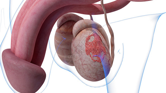 IB阶段睾丸癌图片