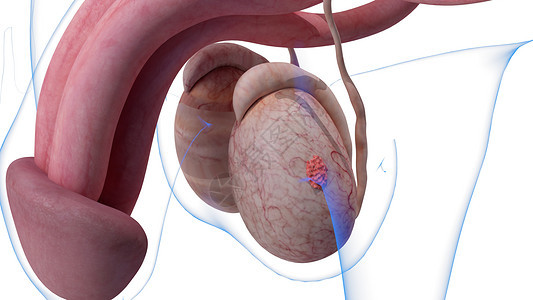 IA阶段睾丸癌图片