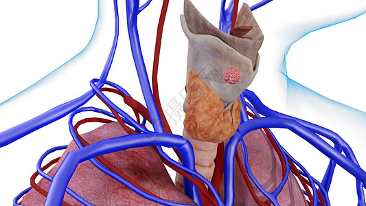甲状腺癌第二阶段图片