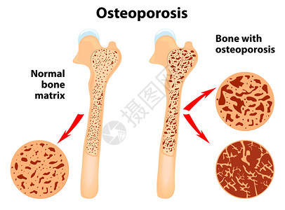 骨质疏松一种骨骼疾病导致图片