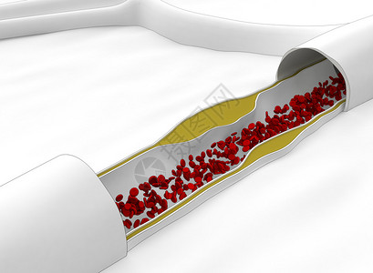动脉壁斑块的形成图片