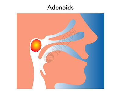 腺样体的简单医学插图图片
