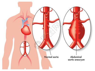 腹主动脉瘤图片