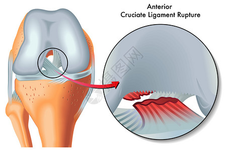 前交叉韧带断裂图片