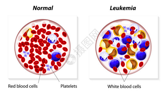 白血病是身体造血组织中的一种癌症图片