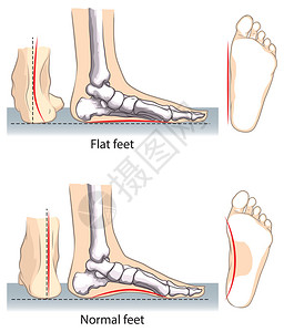 腿骨扁平和正常的脚插画