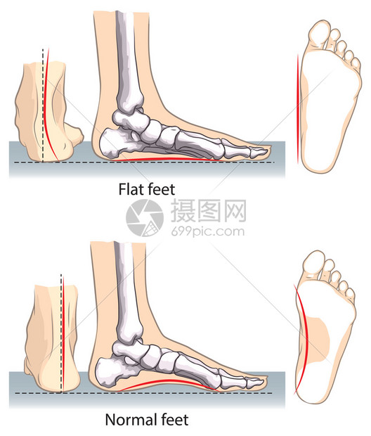 扁平和正常的脚图片