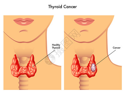 白色背景下人类甲状腺癌的矢量图解图片