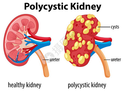显示多囊肾插图的表图片