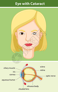 图表显示眼睛与白内障插图图片
