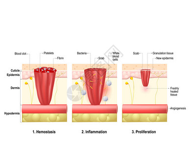 伤口愈合创伤后身体组织修复的过程伤口愈合阶段图片