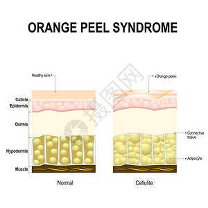 脂肪团也称为橘皮综合症健康的皮肤图片