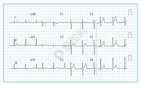 心脏电图表向量检查心电图上波形的插图心律图片