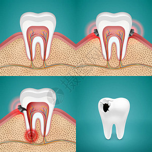 牙痛概念图片
