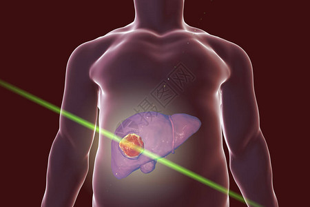使用激光进行肝癌治疗概念图图片