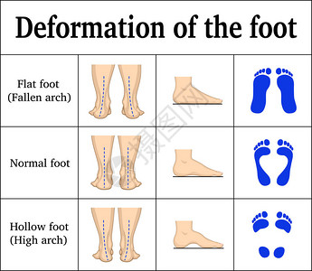 结盟足部变形图解扁平足和空心足有脚印设计图片