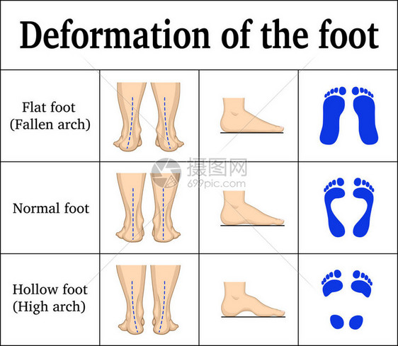 足部变形图解扁平足和空心足有脚印图片