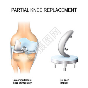 部分膝关节置换术单间室膝关节置换术和单膝关节植入物图片