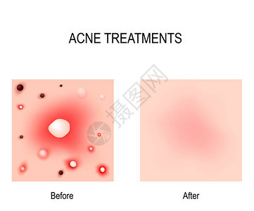 痤疮治疗之前和之后皮肤问题背景图片