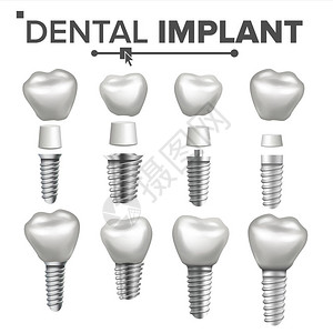 牙种植体集载体植入结构冠图片