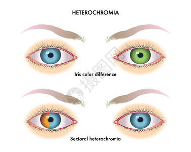 人类眼睛有异地偏图片