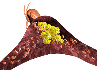胆固醇形成图片