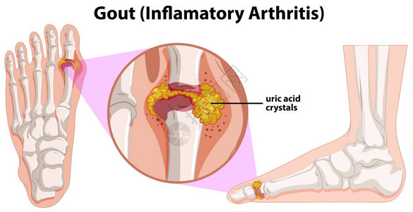 Gout插图图片