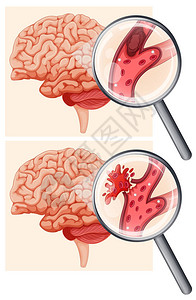 人脑和出血中风图图片