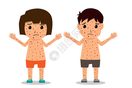 儿童有分布图海报儿童发烧和天花症状及预防背景图片