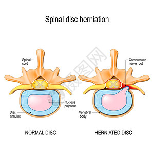 脊椎骨中的正常盘片和脊髓膜损伤图片