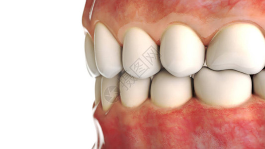 牙科概念人类牙或假牙图片